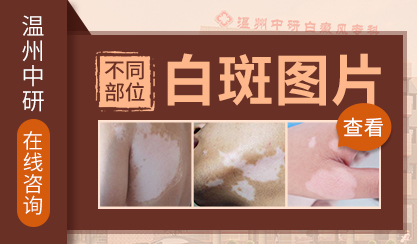 溫州白癜風醫院排名